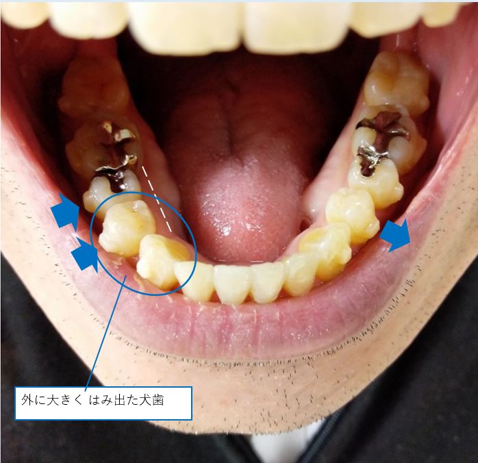 2011019 下の歯　移動予定解説